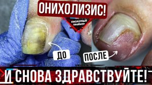 СНОВА ОН! ОНИХОЛИЗИС ногтей на большом пальце? Причины онихолизиса? Онихолизис Большого Ногтя??