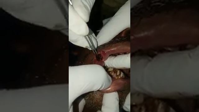 Maggots in mouth, poor oral hygiene and tabacco chewing, a case of Odisha смотреть онлайн
