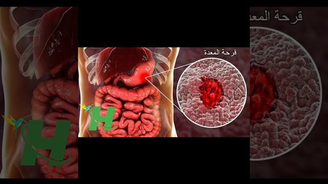 أسباب قرحة المعدة،أعراضها وطرق علاجها‼️ وصفات _مجربة وفعالة بإذن الله смотреть онлайн