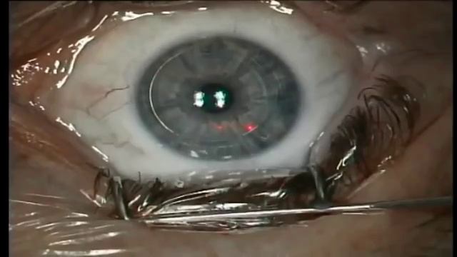 Лазерная Коррекция Зрения - видео операции смотреть онлайн