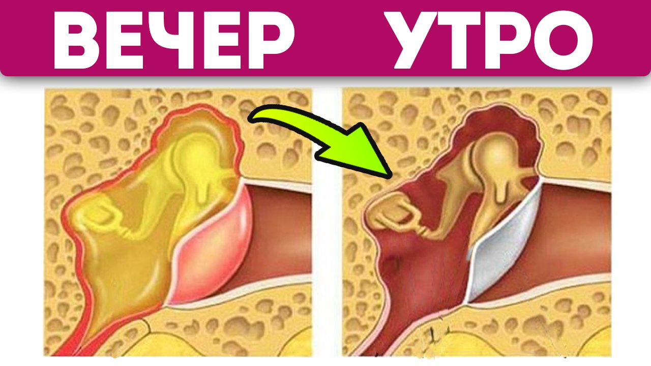 Отит сам себя растворяет, после домашних средств. Лечение отита смотреть онлайн