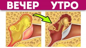 Отит сам себя растворяет, после домашних средств. Лечение отита