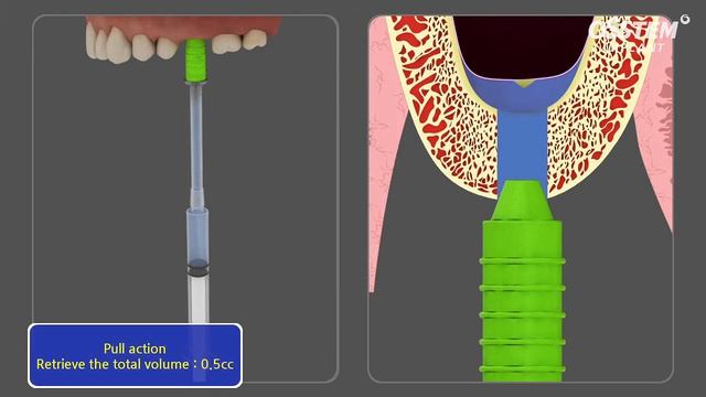CAS KIT: Crestal Approach - Sinus KIT смотреть онлайн
