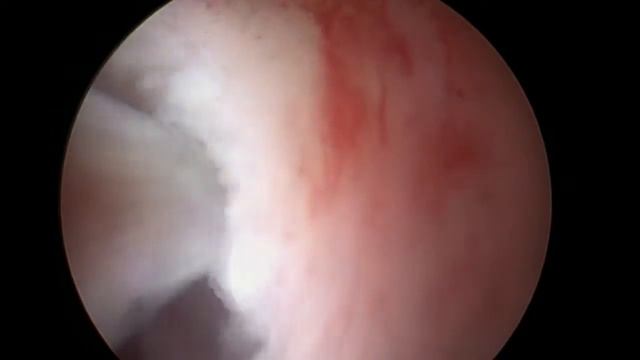 G2/ 3 - 3 5 Cm Submucosal Myoma -  IBS Treatment