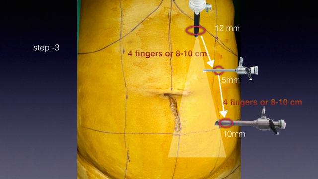 e-TEP RS repair for infra-umbilical Incisional hernia смотреть онлайн