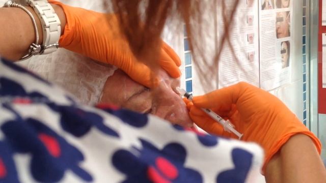 ПРАКТИКА учеников по введению БОТУЛОТОКСИНА при глубоких мужских морщинах. смотреть онлайн