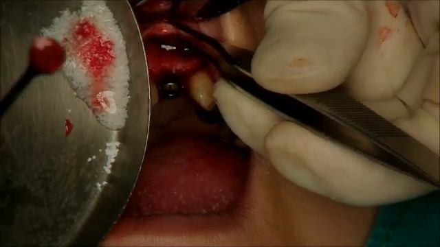 Astra Tech Implant placement area 22 смотреть онлайн