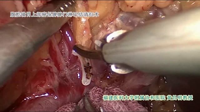 Asvide: Laparoscopic spleen-preserving splenic hilar lymph node dissection for proximal gastric... смотреть онлайн