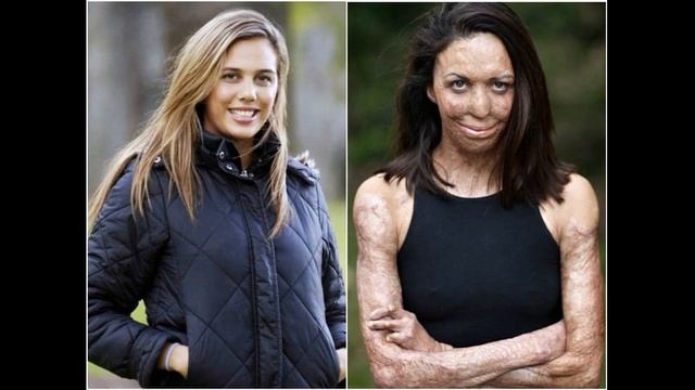 Восставшие из пепла 5 красавиц, которым сожгли лица но не личное счастье смотреть онлайн