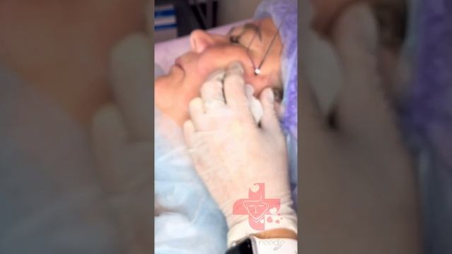 Нити Cogs (коги) #косметология #нити