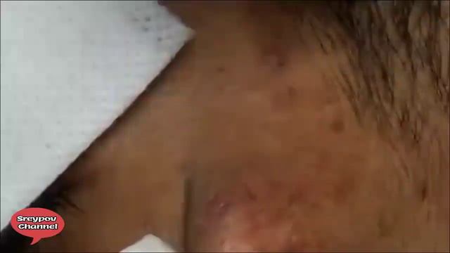 Part 02   How To Removal Blackhead And How To Get Rid Of Blackhead On Face