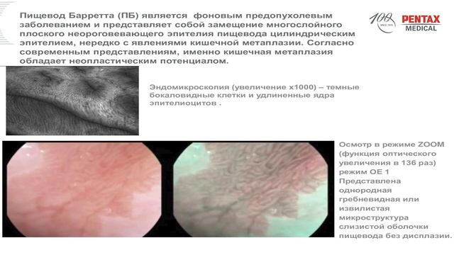Применение технологий iScan и MagniView Optical Zoom в гастроскопии. смотреть онлайн