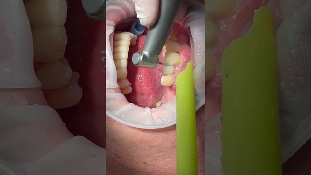1-й этап обработки зубов под коронки: СЕПАРАЦИЯ. #цифроваястоматология #3dstomatolog #виниры смотреть онлайн