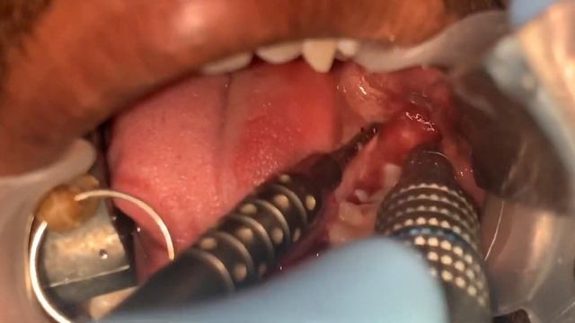 Minor oral surgery video at Richardsons NABH hospital - wisdom tooth removal made easy in India смотреть онлайн