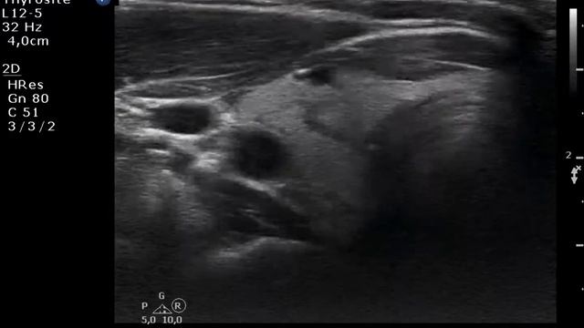 Nodule 119 - study on intranodular hyperechogenic figures смотреть онлайн