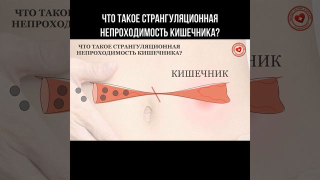 Что такое странгуляционная непроходимость кишечника? #кишечник #болитживот #живот #пищеварение смотреть онлайн