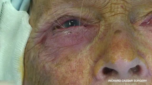 Entropion Repair With Modified LTS And Everting Sutures