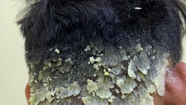 Царапины от перхоти большими хлопьями ( Big Flakes ) #645