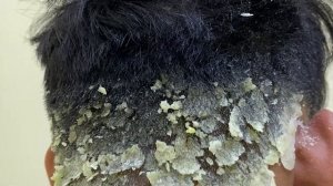 Царапины от перхоти большими хлопьями ( Big Flakes ) #645