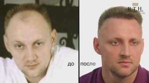 Пересадка волос в Real Trans Hair: отзывы пациентов