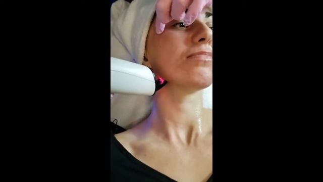 Candela Medical Nordlys Frax 550 Laser смотреть онлайн