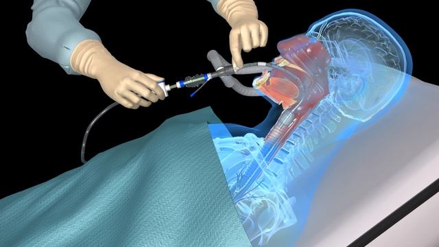 Suctioning the endotracheal tube - medical animation смотреть онлайн