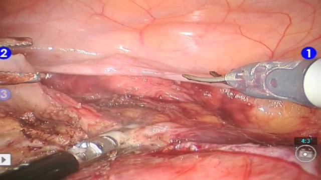 Robotic Hysterectomy for Large Uterine Fibroids and Endometrial Caner смотреть онлайн
