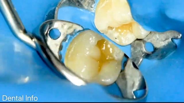 Direct Posterior Restoration | Class 1 Caries смотреть онлайн