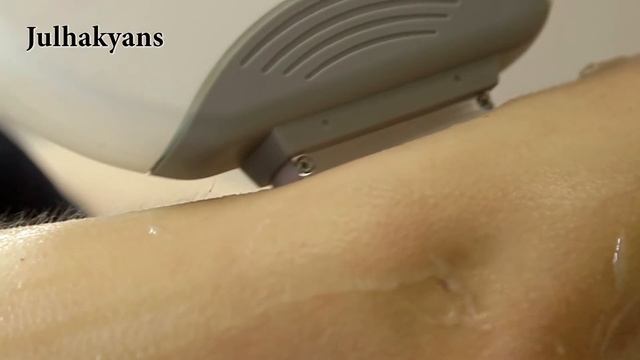 SHR- IPL , ELOS , E – Lite. Julhakyans смотреть онлайн