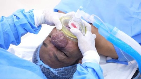 Man with Large Grown Hemangioma in Nose goes under Anesthesia