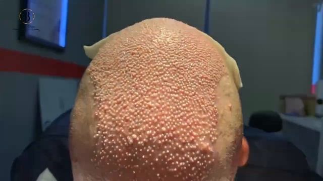 Пересадка волос до и после, начальный результат пересадки волос Дмитрия из России смотреть онлайн