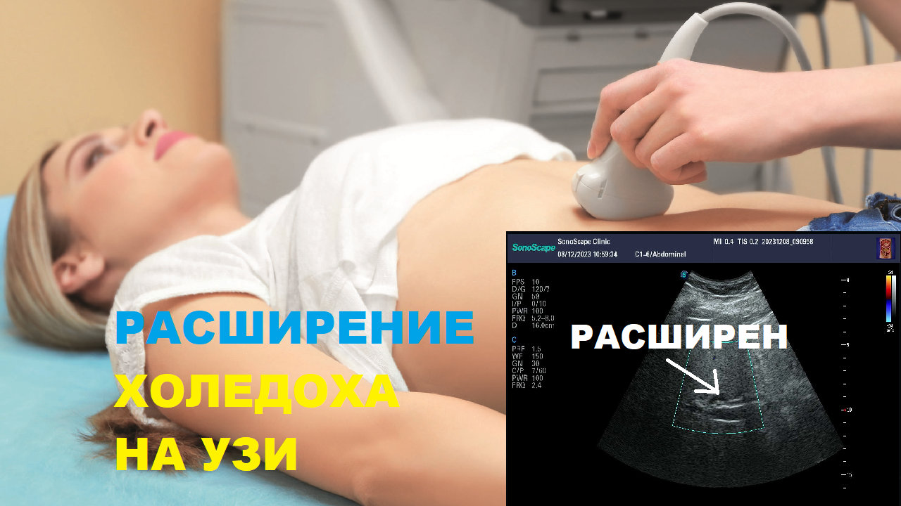 Как выглядит РАСШИРЕННЫЙ ХОЛЕДОХ на УЗИ? смотреть онлайн