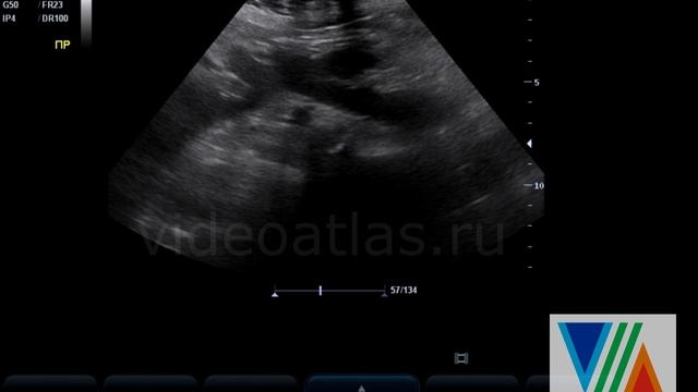 Подковообразная почка и дистопия почки смотреть онлайн