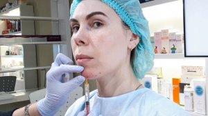 Филлеры. Нижняя треть. Подбородок(фрагменты).