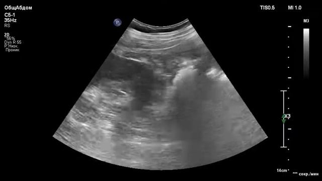 УЗИ правой почки. Злокачественная опухоль. Ultrasound diagnostics. Kidney. Cancer. смотреть онлайн