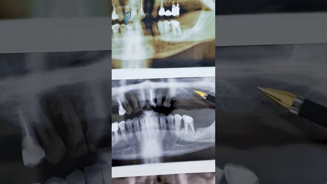Трансформация улыбки пациента через рентген. Имплантация зубов. смотреть онлайн