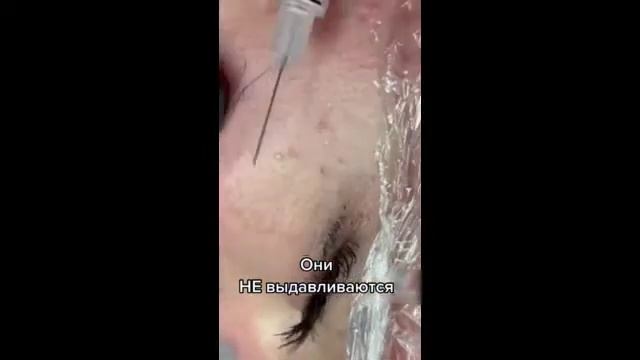 Просянка и Жировики. Ответ Косметолога - Как Правильно Избавиться от Прыщей (2021) смотреть онлайн