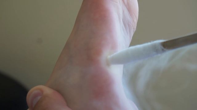 Удаление бородавок жидким азотом. Криодеструкция