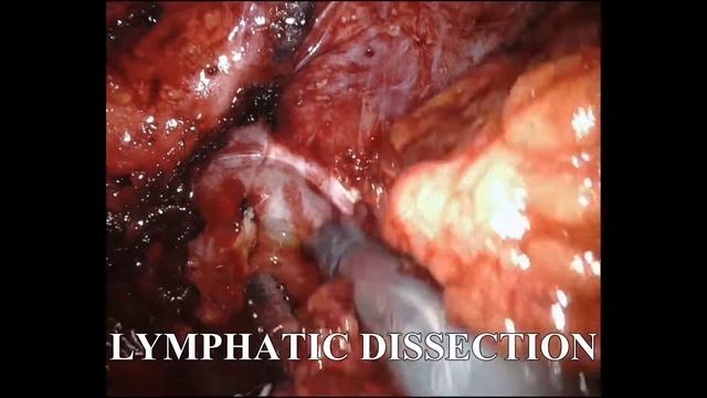 salvage pelvic lymph node dissection for post rare node only recurrence смотреть онлайн