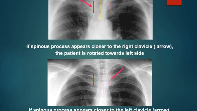 Chest X Rays Basics смотреть онлайн