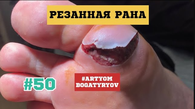 50. Наложение вторичных швов на рану