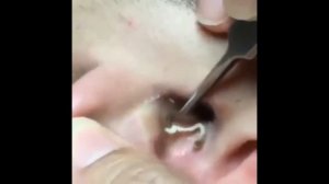 Подборка мерзостей,угри,прыщи,черные точки/A selection of abominations,blackheads,pimples,black dot