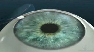 Что такое лазерная коррекция зрения