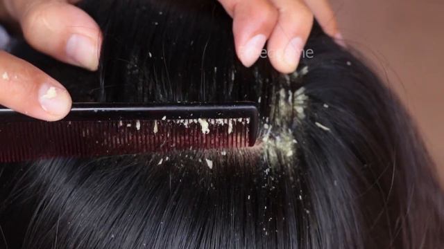 Wow!! Huge Dandruff Flakes Removal!! Itchy Psoriasis Scalp Dandruff Scratching on Sister Hair смотреть онлайн