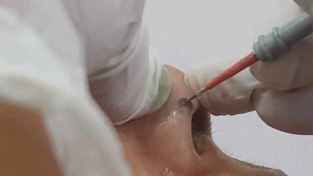 Mole removal from Nose with Radiofrequency .. смотреть онлайн