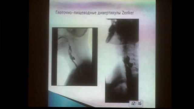 07 Пузаков КБ Лучевая диагностика дивертикулов пищевода смотреть онлайн