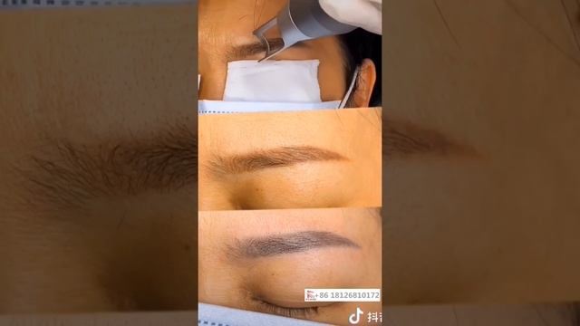 eyebrow removal picosecond laser смотреть онлайн