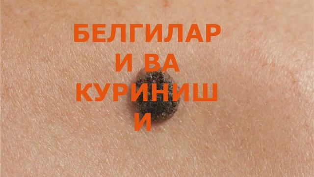 ЛИМФА ТУГУН КАТТАЛАШИШИ (КУЛТИК ОСТИДАГИ ЛИМФА ТУГУНЛАРИ ПУНКЦИЯ ВА БИОПОСИЯСИ) смотреть онлайн