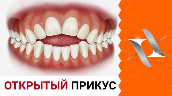 ОТКРЫТЫЙ прикус. Причины. Последствия.