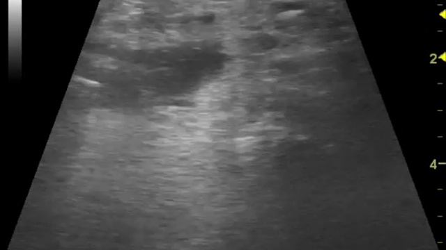 Сиалолитиаз подчелюсной слюнной железы смотреть онлайн